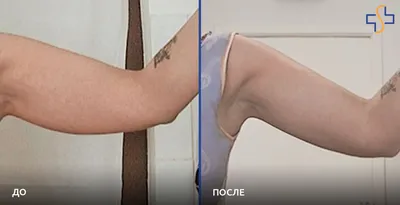 Подтяжка рук (брахиопластика) фото до и после