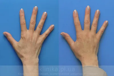 Пластика рук (брахиопластика) в Турции, Стамбул | Цена ▷ ТОП-10+ клиник 2024
