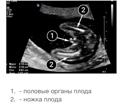 1 скрининг беременных | УЗИ 12 недель | Что видно на скрининге первого  триместра? Пол ребенка - YouTube