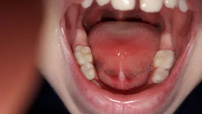 У дочки 6 лет порвалась верхняя уздечка - Вопрос стоматологу - 03 Онлайн