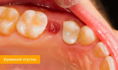 Состояние лунки после удаления зуба мудрости - Хирургическая стоматология -  Стоматология для всех