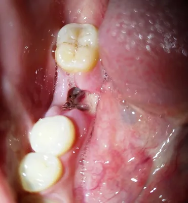 После удаления зуба в лунке появилось что-то белое. Что это может быть?» —  Яндекс Кью