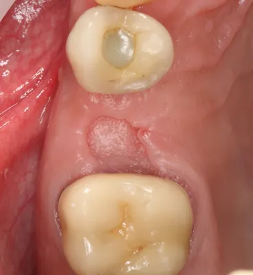 Для пациентов. Поговорим об удалении зуба — IMPLANT-IN.COM — дентальная  имплантация. естественно.