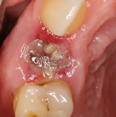 Альвеолит после удаления зуба: фото, лечение, сухая лунка | Dental Art