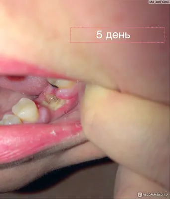 Боли после удаления зуба - Альвеолит - YouTube