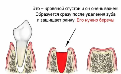Белый налет на десне после удаления зуба — что означает налет на ране в лунке  после удаления зуба мудрости?
