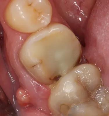 Что делать после удаления зуба — стоматологическая клиника Эталон Ростов
