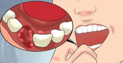 Киста после удаления зуба: кто виноват и как лечить заболевание | Dental Art