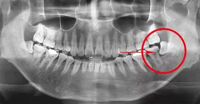 Альвеолит лунки после удаления зуба – что это, причины, симптомы, лечение