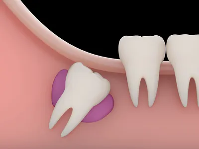Удаление зуба с кистой на корне — показания, как происходит процедура, боль  при удалении