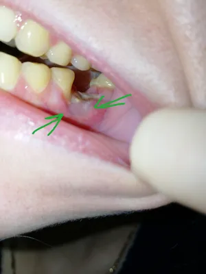 Белый налет после удаления зуба | ПрезиДЕНТ