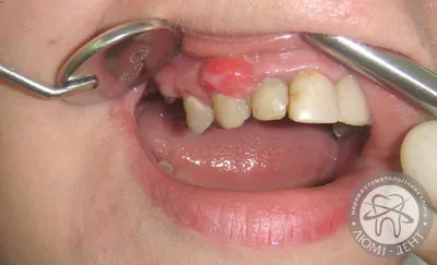 Удаление зуба мудрости без неприятных последствий | Клиника Колибри