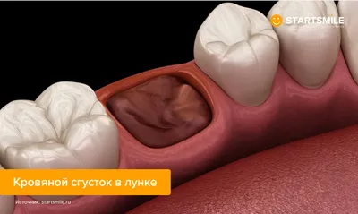 Белое пятно на десне - почему возникает, что делать