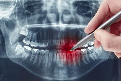 После удаления зуба остался кусочек, осколок в десне — что делать, если  вырвали зуб без корня
