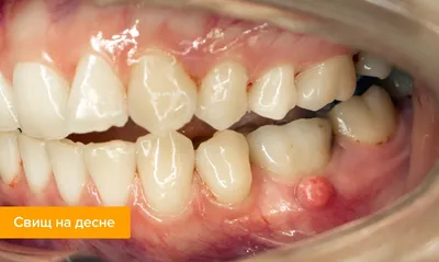Сроки заживления лунки зуба после удаления | ВКонтакте