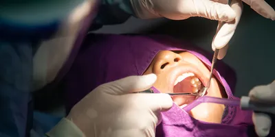 Вставить зуб на место удаленного: цена установки импланта