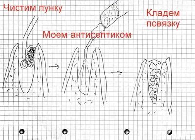 Воспалилась десна после удаления зуба: почему так происходит и что нужно  делать?