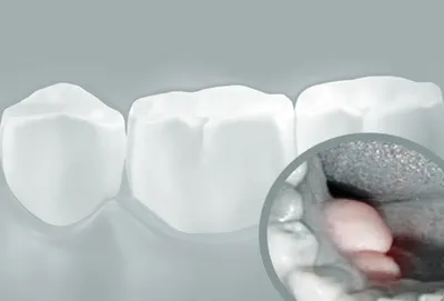 Белый налет после удаления зуба - что это такое? Статья клиники DentalOpera