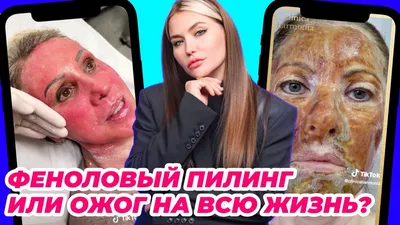Пилинг для лица GIGI MEDIC PEEL Acne Peel - «Результат после пилинга с  ежедневными фото» | отзывы
