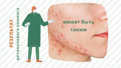 Пилинг, который сжигает лицо - YouTube