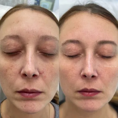 Желтый пилинг для лица в Киеве - Coolaser Clinic