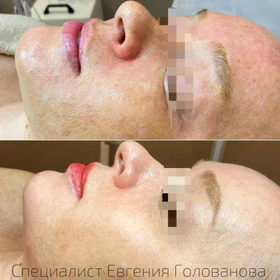 Побочные эффекты после пилинга: профилактика, диагностика, лечение