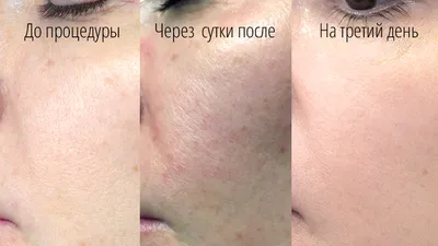 Ультразвуковой пилинг кожи лица: цена, противопоказания - клиника Абсолют  Мед