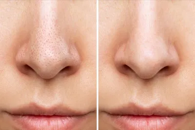 Гибридный ТСА пилинг мягкого действия TCA hybrid safe peeling - купить по  лучшей цене в интернет-магазине корейской косметики Ramosu | Киев, Украина
