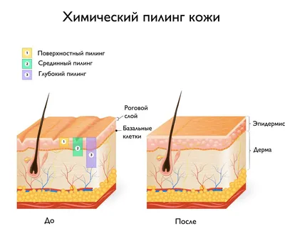 Пилинг при розацеа (купероз) – Биокосметолог