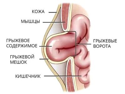 Послеоперационные вентральные грыжи — Операции в Харькове | Хирургия ОМИХ