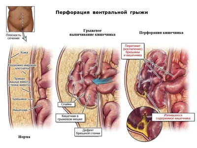 Грыжи - причины появления, симптомы заболевания, диагностика и способы  лечения