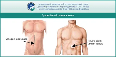 Грыжа белой линии живота в Калининграде: операция и лечение, цены и отзывы  на сайте
