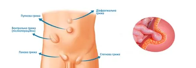 Послеоперационная вентральная грыжа - удалить в СПб | Клиника МедПросвет