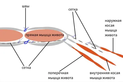 Лечение послеоперационной грыжи в Москве - лечение в Университетской  клинике МГУ им. М.В. Ломоносова