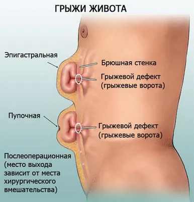 4 грыжи одновременно: паховая грыжа справа, послеоперационная грыжа боковой  области живота слева после операции на почке, пупочная грыжа и грыжа белой  линии живота над пупком.