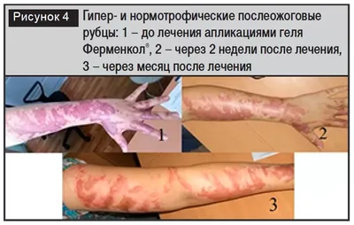 Оценка противорубцовой эффективности препарата Ферменкол - ФЕРМЕНКОЛ