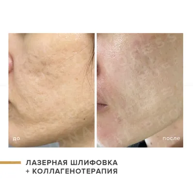 Комплексное лечение постакне
