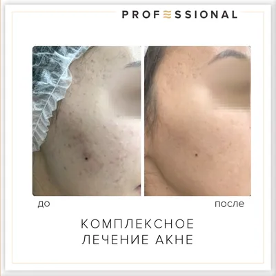 Результат комплексного лечения акне и постакне