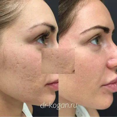 Боремся с рубцами постакне на лице - Cosmetic-clinic