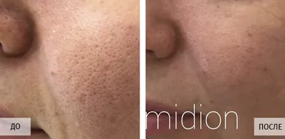 Фотографии до и после лечения постакне на Acupulse, проводим в клинике  Premium Aesthetics