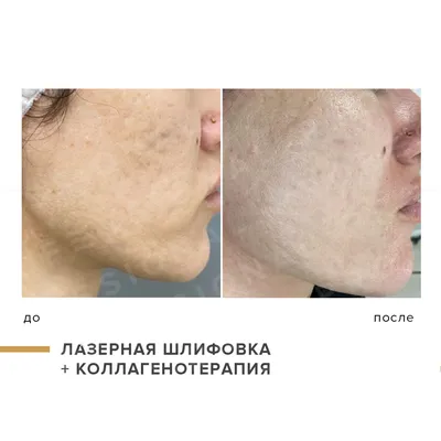 Фотографии до и после лечения постакне на аппарате Acupulse, проводим в  клинике Premium Aesthetics