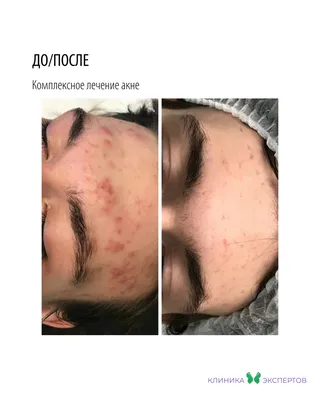 Комплексное лечение постакне