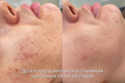 Лазерное удаление постакне цена в Санкт-Петербурге, лечение и подготовка к  сеансу