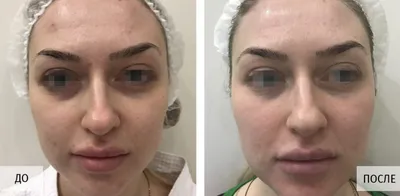 Фотографии до и после лечения рубцов постакне на аппарате М22: ResurFX в  клинике Premium Aesthetics, пациент 4