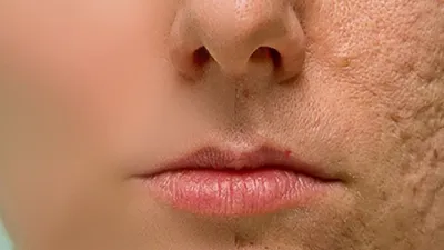 Парафармацевтика / Уход за кожей Bioderma Себиум (Sebium AKN) - «Bioderma  Sebium AKN или как избавиться от постакне. (фото \"ДО\" и \"ПОСЛЕ\")» | отзывы