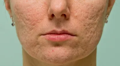 Фотографии до и после лечения акне и постакне M22+Fraxel, проводим в  клинике Premium Aesthetics