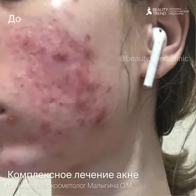 Постакне – лечение в медцентре «Номосклиник» | Стоимость процедуры в  Москве, отзывы, вопросы и ответы