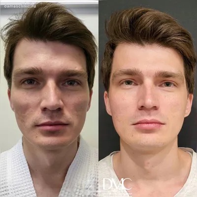 Шлифовка постакне/рубцов на лазере (СO2, SmartXide) в Москве по цене от  2500 руб. в клинике Beauty Trend