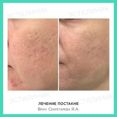 Фотографии до и после лечения рубцов постакне М22: ResurFX, проводим в  клинике Premium Aesthetics