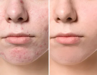 pbserum.kz - На фото результат ДО и ПОСЛЕ процедур против #постакне. Было  проведено 3 процедуры с использованием препаратов SMOOTH+ (коллагеназа) и  DRAIN+ (гиалуронидаза) и 2 процедуры с применением препарата LIFT+.  Специалисту удалось